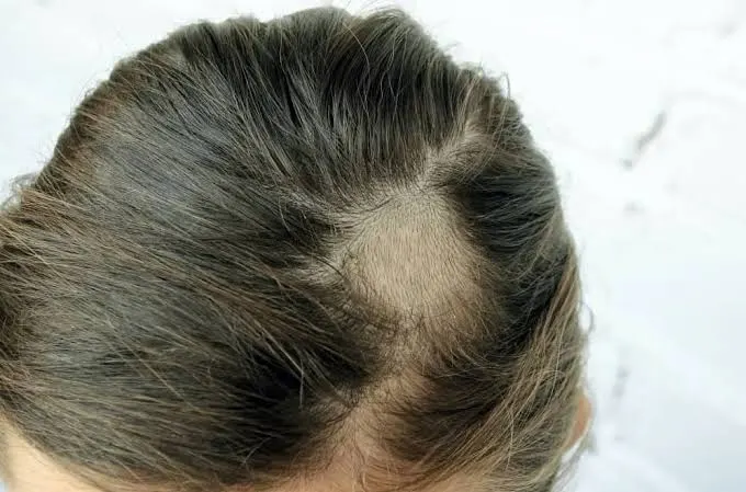 Tinea Capitis