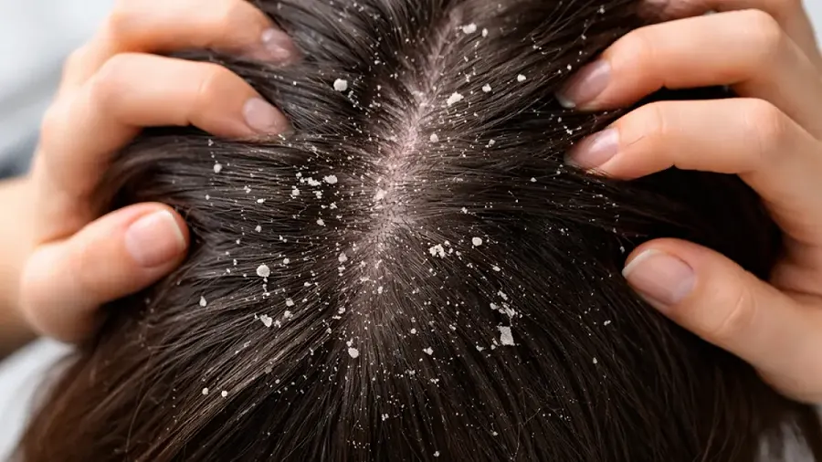 ketombe jamur