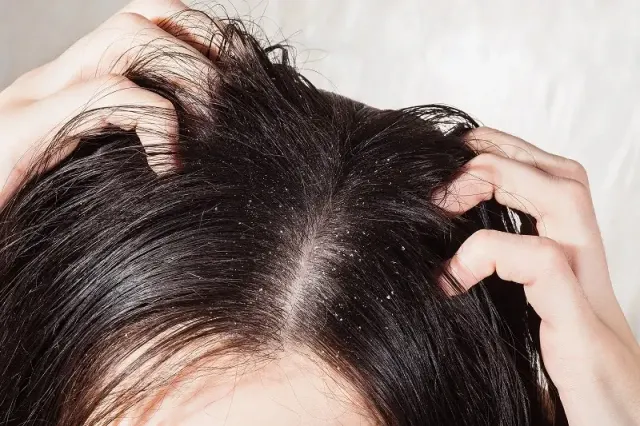 7 Perubahan Hormonal Pemicu Ketombe yang Perlu Kamu Ketahui