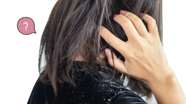 5 Kebiasaan Sepele Pemicu Rambut Ketombe yang Sering Diabaikan